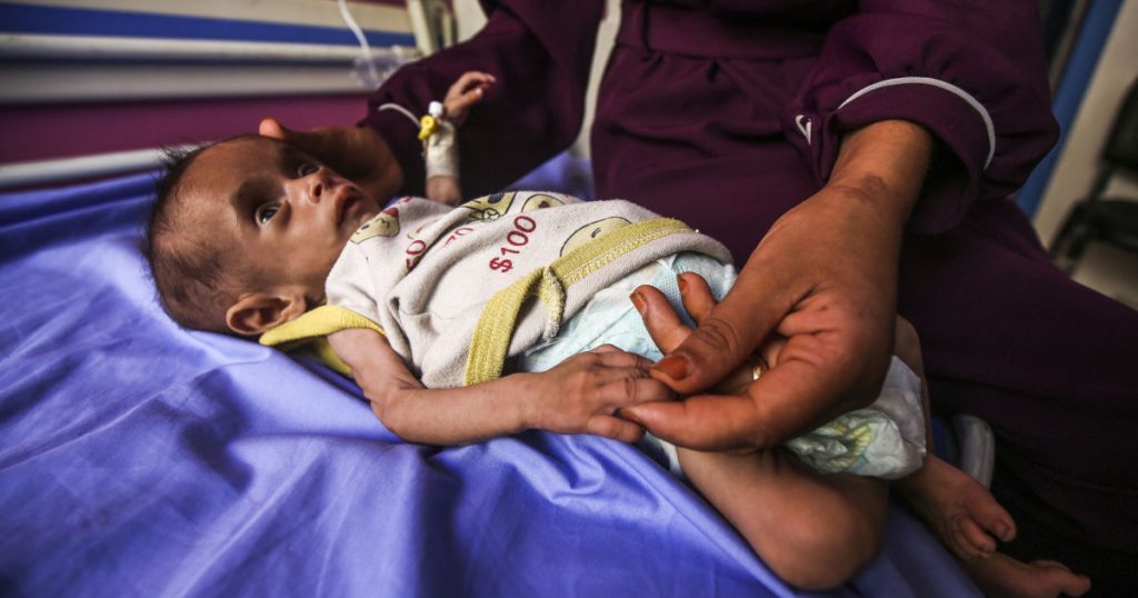 Infometare in masa in Gaza copii malnutriti
