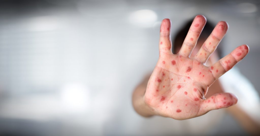 Moartea unui copil de rujeola a starnit conspiratii antivacciniste
