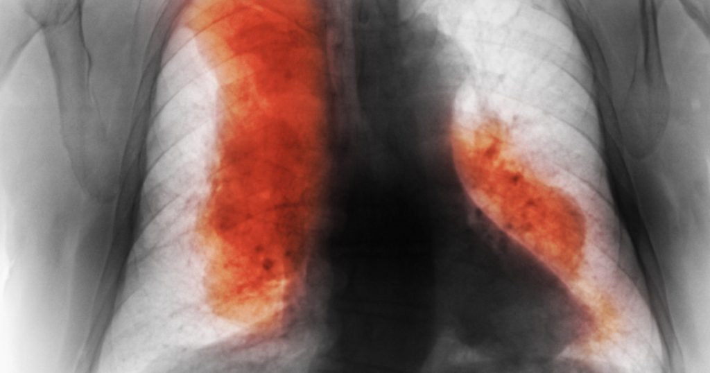 Decesele cauzate de cancer vor creste semnificativ pana in 2050